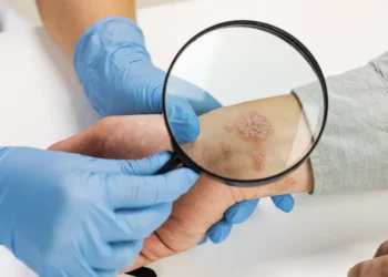 psoriasis déclencheur peau dermatite eczéma lemirak